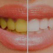 How To Basic Whiten Teeth