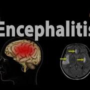 Encephalitisby