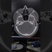 Pns Viral