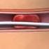 Treatment Of Acute Ischemic Stroke With Clot Retrieval Device