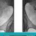 Hysterosalpingogram HSG