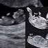 It S A Baby Girl Nub Theory Ultrasound Case