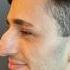 Rhinoplasty Result Dr Ahmet Dilber Plasticsurgery Rhinoplastyturkey Rhinoplasty