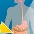 What Is Crohn S Disease