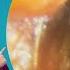 2cm Ear Wax Plug Satisfying Peel Deep Ear Wax Microsuction Compilation EP1144