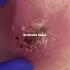 Beyoncé Infection Dr Khaled Sadek Blackheadremoval Skincare Blackheads LIPOMACYST Com