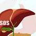 Symptoms Of Gall Bladder Attack I Gallbladder Pain 7428617074
