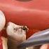 Surgical Extraction And Bone Graft