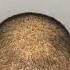15 DAY TRANSFORMATION See His Hair Before And After Sapphire FUE Hair Transplant
