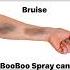 Bruised BooBoo Spray Helps Your Bruise To Heal Faster