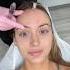 The Perks Of Your Mom Being An Injector Filler Microneedling Girl