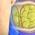 Cellulite Laser Treatment ABC 7 Report Zapping Cellulite