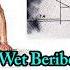 Thiamine Deficiency Beriberi Dry Beriberi VS Wet Beriberi