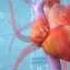 Angioplasty Procedure Animation Video