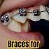 Braces For Overbite Teeth Transformation Braces Orthodontist Dentist