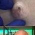 Doctor Reacts To MASSIVE Cyst Dermreacts Doctorreacts Pimplepop Cystpop