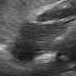 Cardiac Arrest Asystole Vs Ventricular Fibrillation Fib Cardiac Ultrasound 07 2021