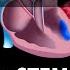 Acute Coronary Syndrome Unstable Angina NSTEMI And STEMI Heart Attack Animation