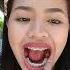 Braces Update May Kakaibang Nilagay Yung Dentist Ko