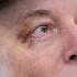 Musk Says Bruised Eye Was Caused By Horsing Around With His Son