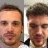 Hair Transplant 8 Months Result