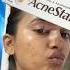 Shortsfeed How To Use Acne Star Gel On Pimple Acne Skincare Skincaretips Pharmacy Pimple