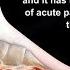 Rupture Of The Plantar Fascia Everything You Need To Know Dr Nabil Ebraheim