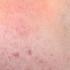 Acne Dying For Clear Skin Full Acne Documentary