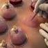 Hijama Cupping Therapy