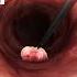 What If You Found A Polyp During Colonoscopy