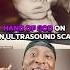Hand Of God On Ultrasound Scan Explained Miracle
