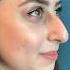 Rhinoplasty Result Dr Ahmet Dilber
