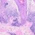 Discoid Lupus Erythematosus Under The Microscope Pathology Dermatology Dermpath