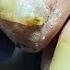 Give An Old Man A Pedicure And Pull Out Stubborn Na Doctor Liu Pedicure