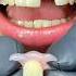 SOLUTION With FLEXIBLE Dental PROSTHESIS Of 1 2 3 Tooth Mrdent Dentist Smile Protesisdental