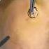 How To Remove Plantar Warts Understanding Treating And Preventing Foot Warts Skinaa Clinic