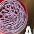 Endovascular Coiling For Brain Aneurysm Animation