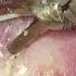 LAPAROSCOPIC PECTOPEXY FOR VAULT PROLAPSE DR LEENA MEHROTRA APEX HOSPITAL