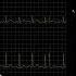 ECG Exercise Stress Testing Using A GE Case System