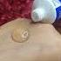 What Is A Wart Removal Cream Massa Removal At Home