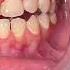 TOOTH FILLING Pasta Sa Ngipin Dentist