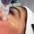 Advanced Microneedling With SkinPen At Donya Medical Spa In Richmond Hill ON