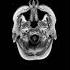 MRI MRV Of The Brain AX TW1 SE POST