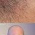 Derm Reacts To BIG Ingrown Hair Dermreacts Doctorreacts Ingrownhair