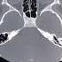 CT SCAN OF PNS Viral Medical Shortfeeds