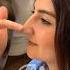 Rhinoplasty Turkey Dr Ahmet Dilber