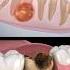Tooth Abscess Problem Dentist Dentisty Teeth Dental