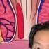 What Is A Hemorrhoid And How Do You Treat It Shorts Hemorrhoids