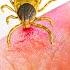 5 Deadly Tick Bites You Need To Worry About
