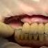 Преображение улыбки пациента Transformation Of The Patient S Smile Implantation